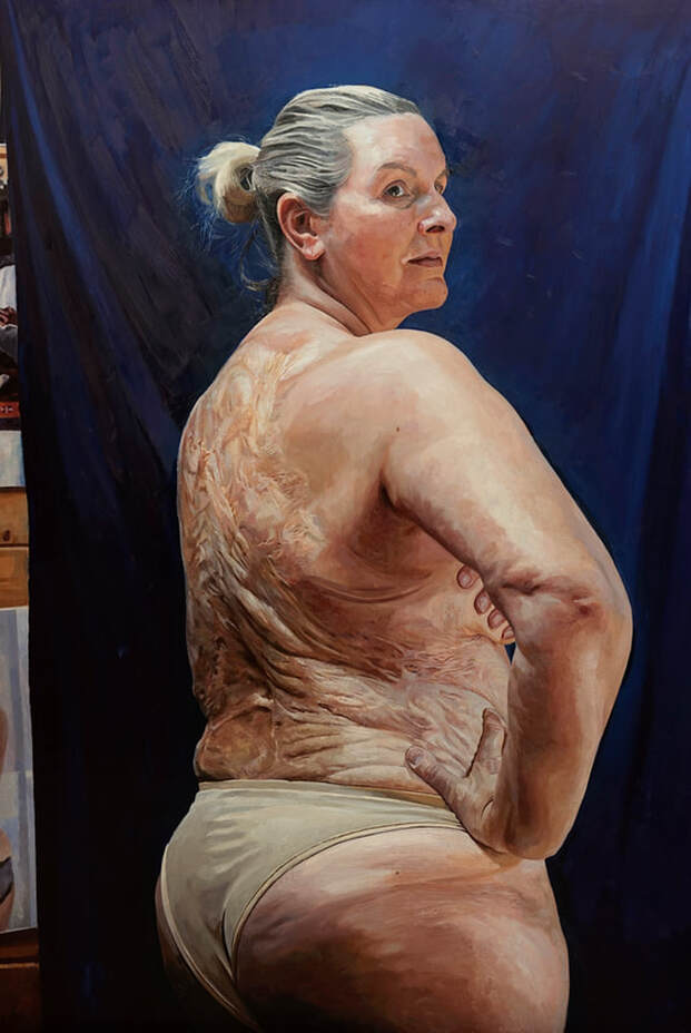 oil painted portrait, skin, Sylvia Mac, Love Disfigure, body positivity campaigner, charitable portrait by artist Alastair Adams, female, women